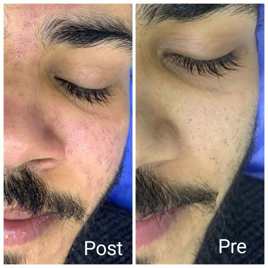 تنظيف عميق للبشرة